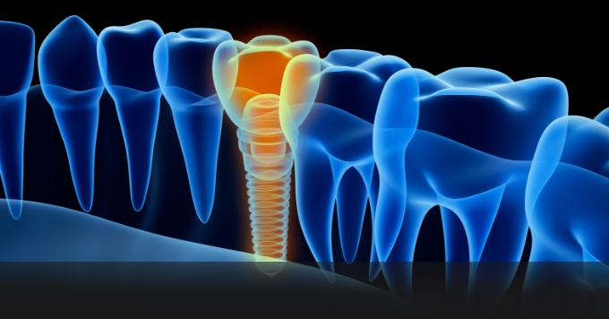 drawing of dental implant
